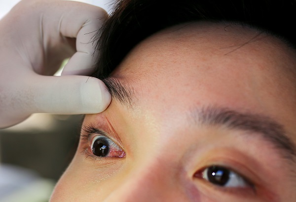 How An Optometrist Can Treat Common Eye Infections